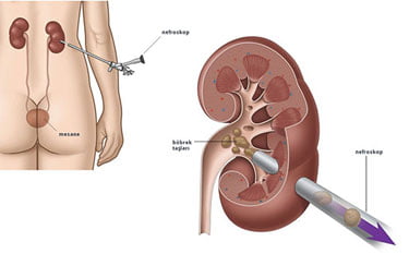 böbrek taşı ameliyatı