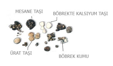 böbrek taşı