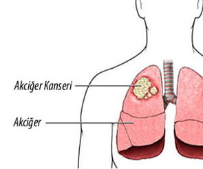 akciğer kanseri